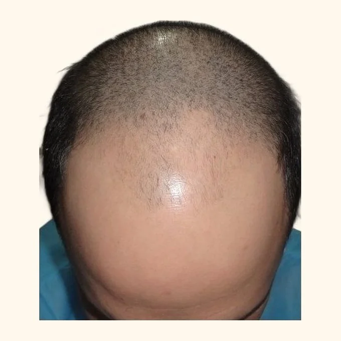 Before hair transplant — full restoration