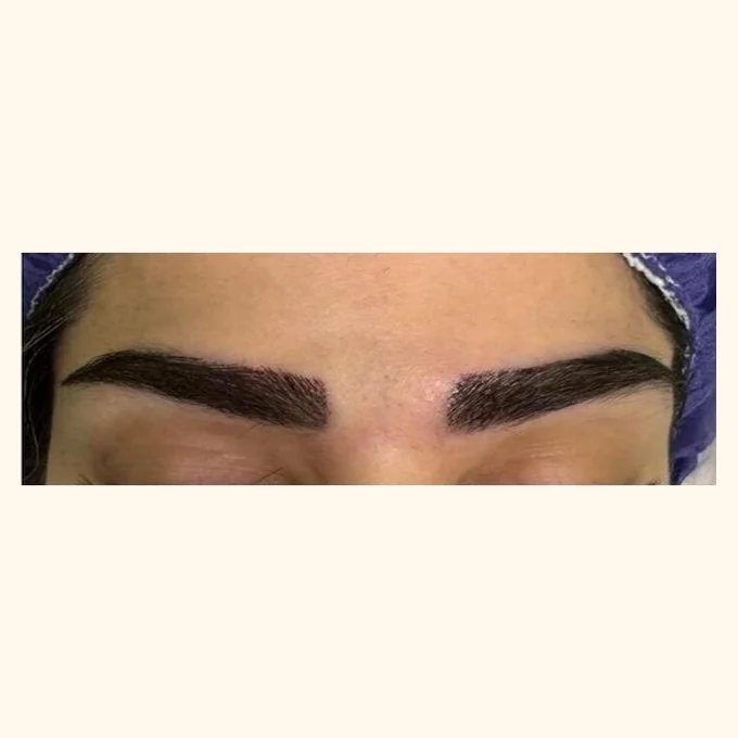 After eyebrow transplant — brow restoration